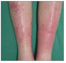 CELULITIS