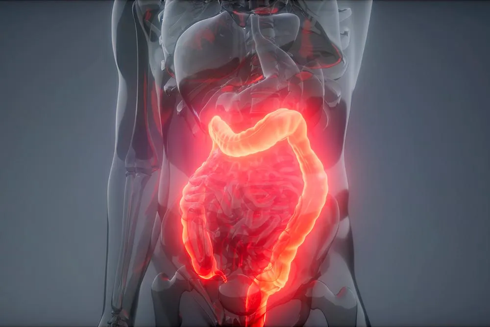colon-irritable