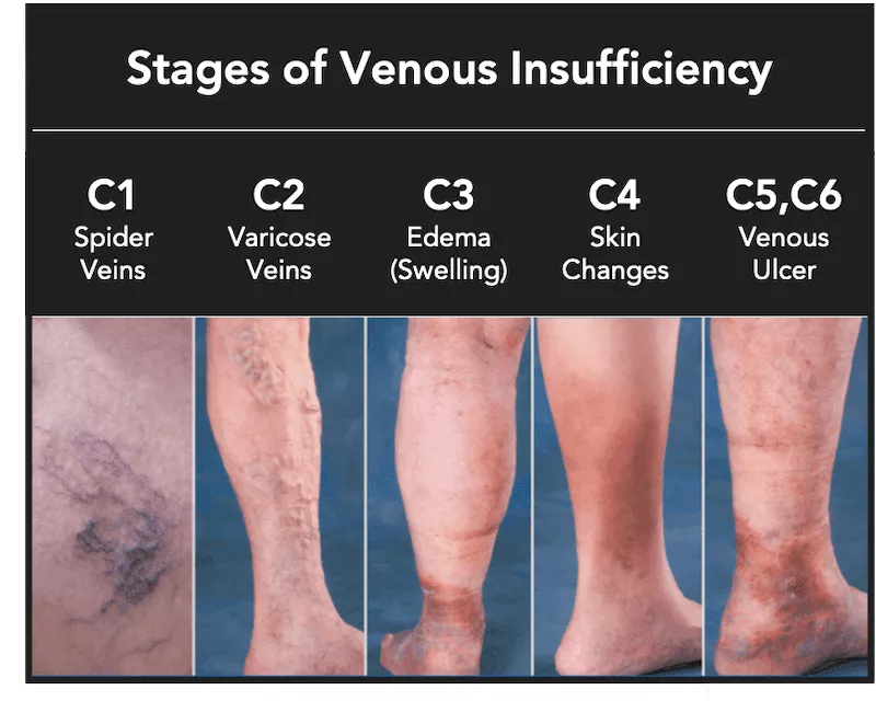 splash-stages-of-venous-insufficiency