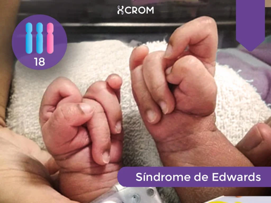 WEB-Sindrome-de-Edwards-1024x768