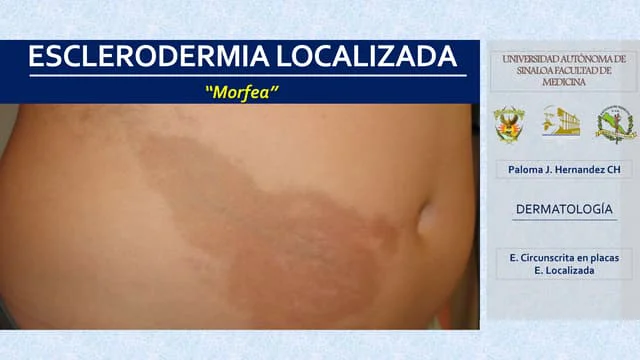 morfea-180405005444-thumbnail